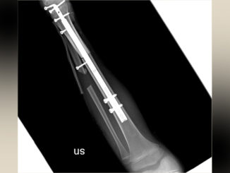 Bimba con raro tumore osseo potrà tornare a camminare: caviglia ricostruita con osso omoplastico ed un chiodo allungabile