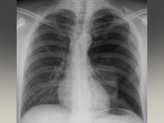 Studio Molinette, ecografia polmone può diagnosticare Covid