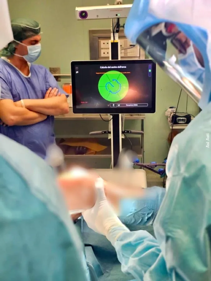 Primo intervento ortopedico con l'aiuto del robot all'ospedale di Asti 3